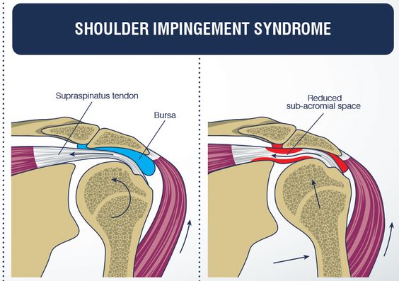 a diagram show what shoulder impingement syndrome looks like