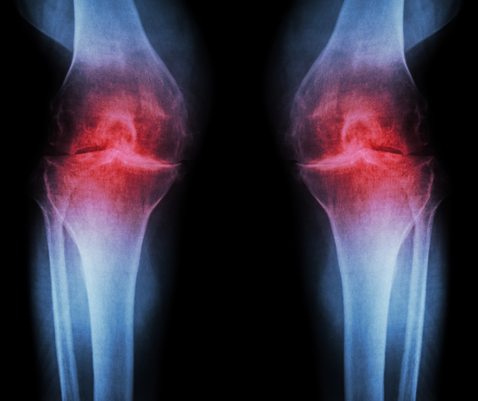 Osteoarthritis in the knees