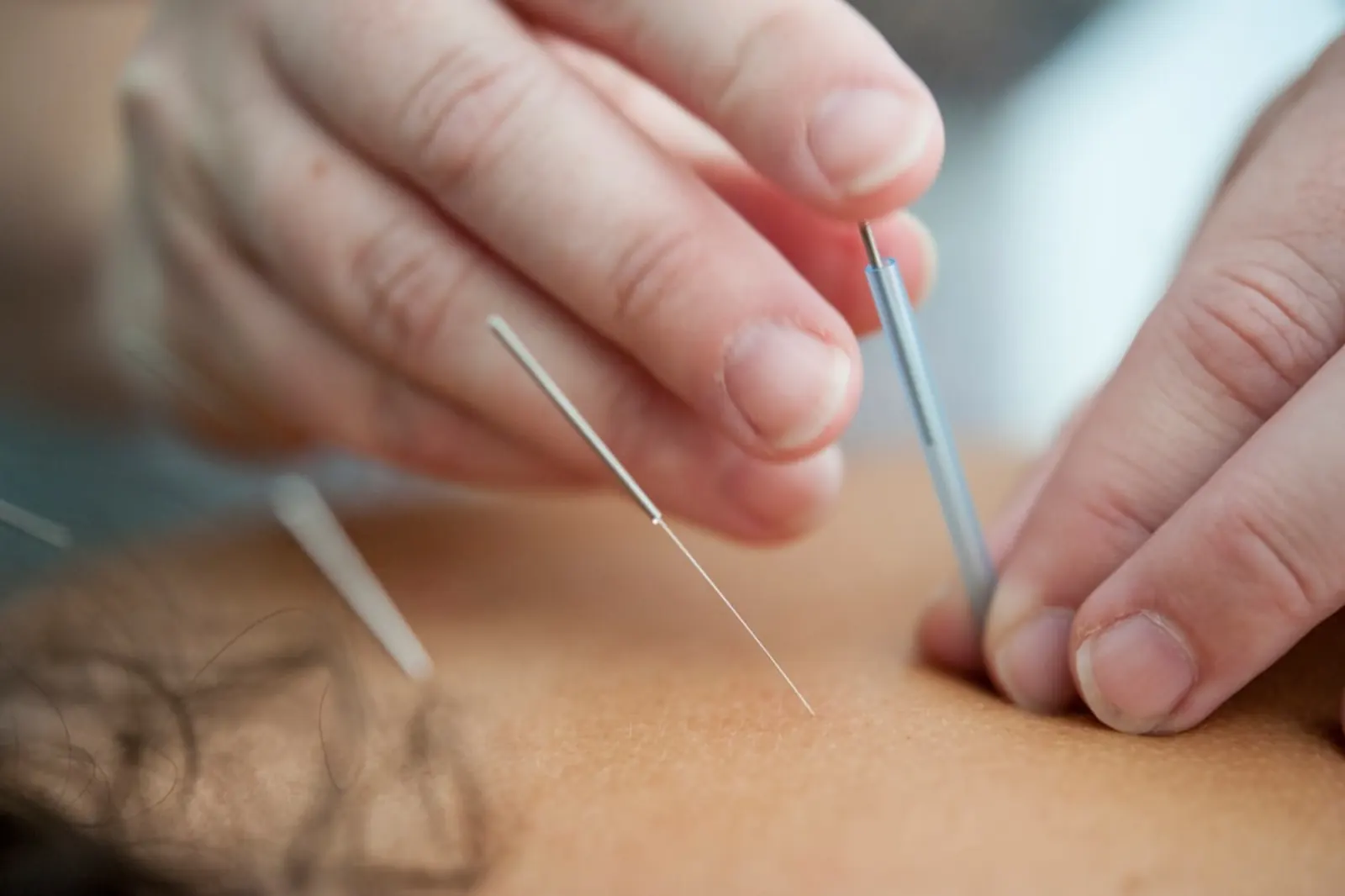 Close up of dry needling applied during treatment